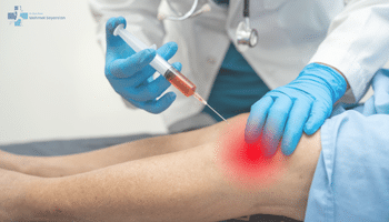 PRP (Platelet Rich Plasma) Tedavisi Nedir? 3 prp tedavisi avantajlari